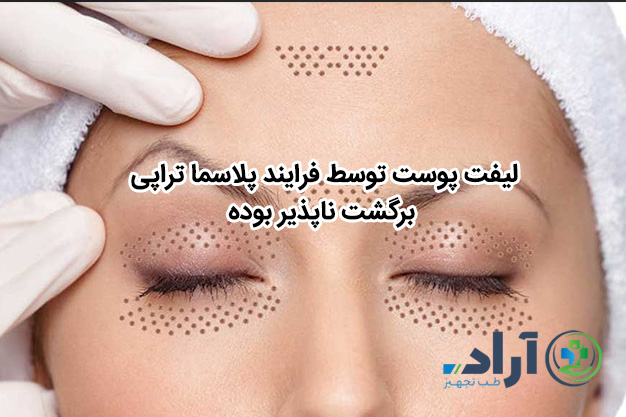لیفت پوست توسط فرایند پلاسما تراپی برگشت ناپذیر بوده