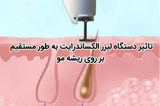 تاثیر دستگاه لیزر الکساندرایت به طور مستقیم بر روی ریشه مو